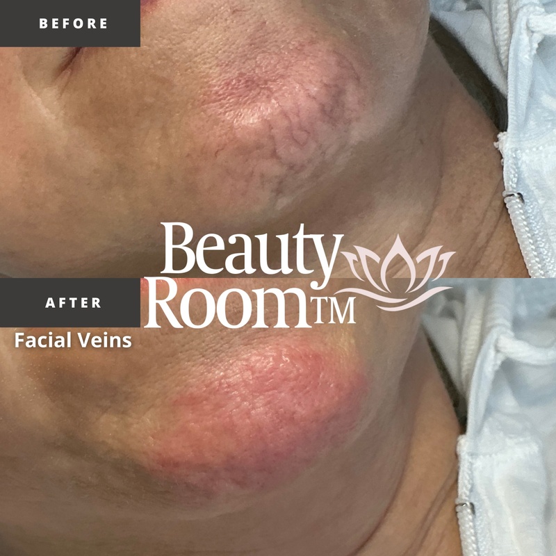 CLEAR Spot Treatment before and after — Facial Veins / Broken Capillaries