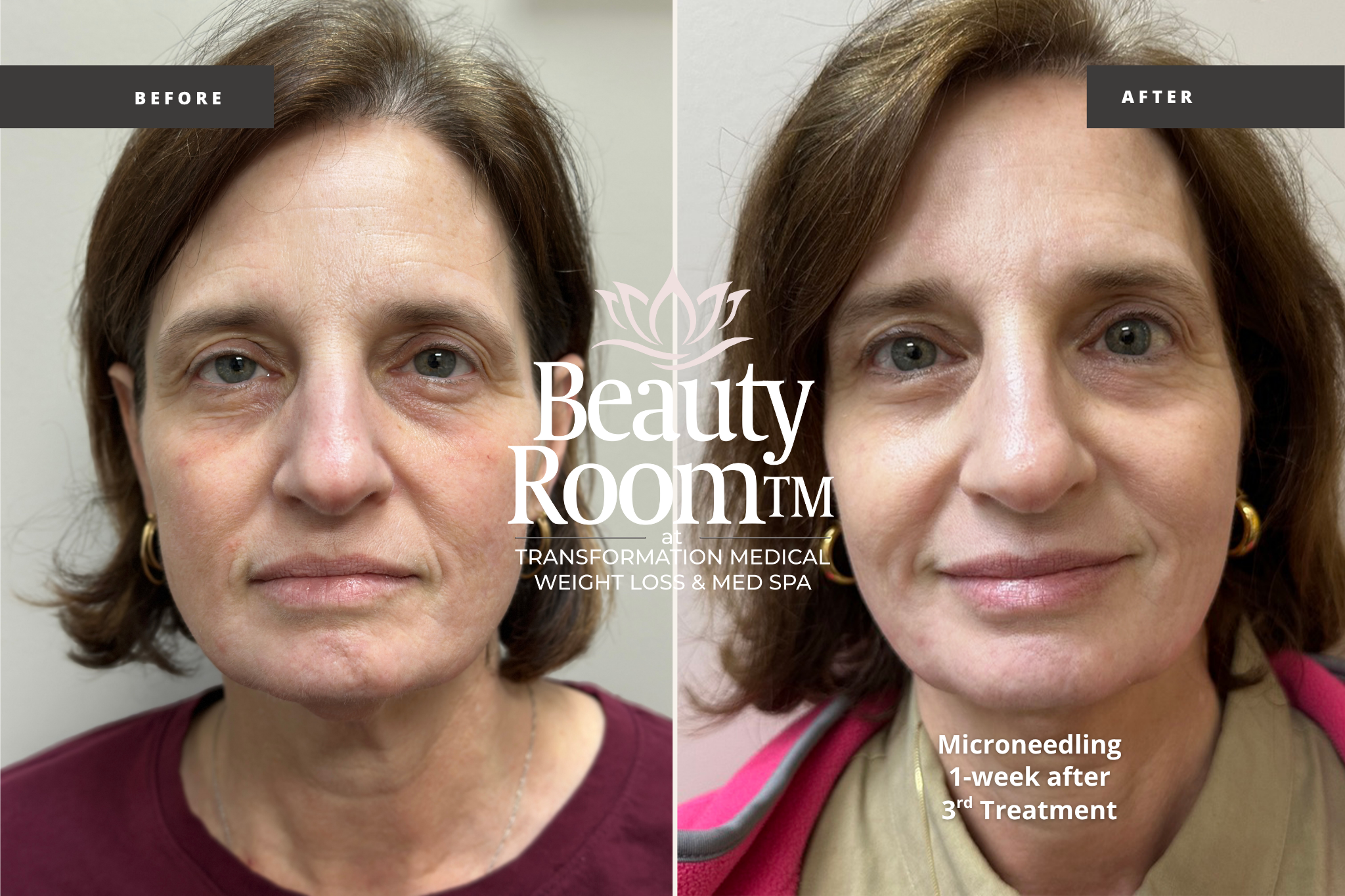 Before and After Image: Microneedling - 