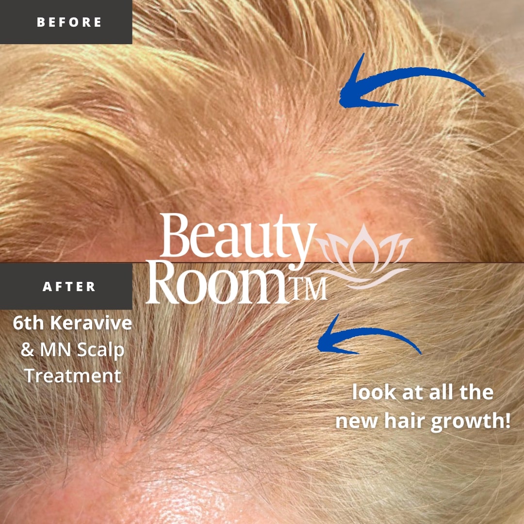 Before and After Image: Scalp Treatment - front