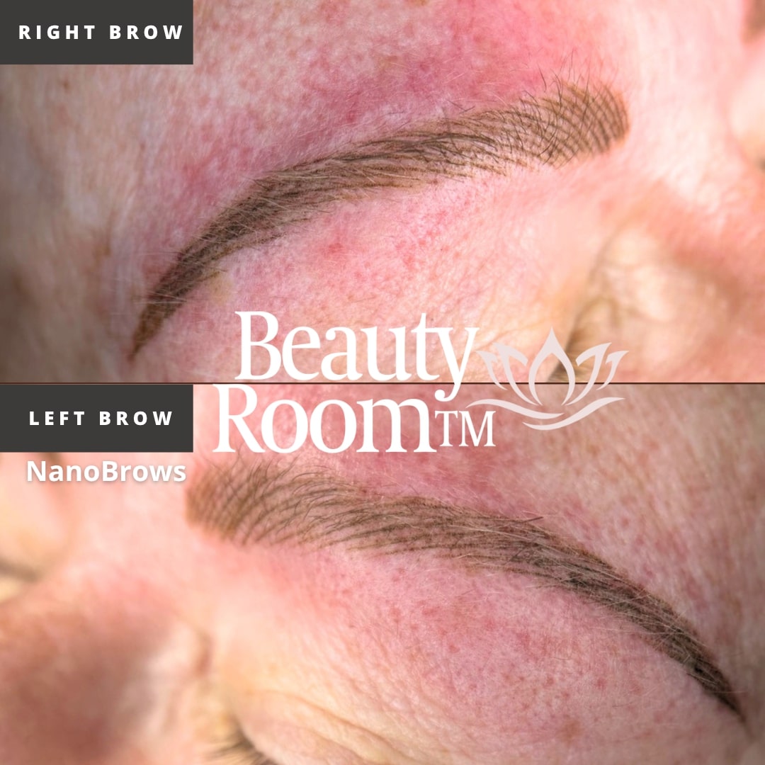 Before and After Image: NanoBrows - front