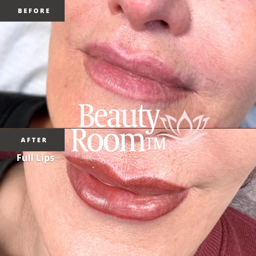 Before and After Image: Full Lips - front