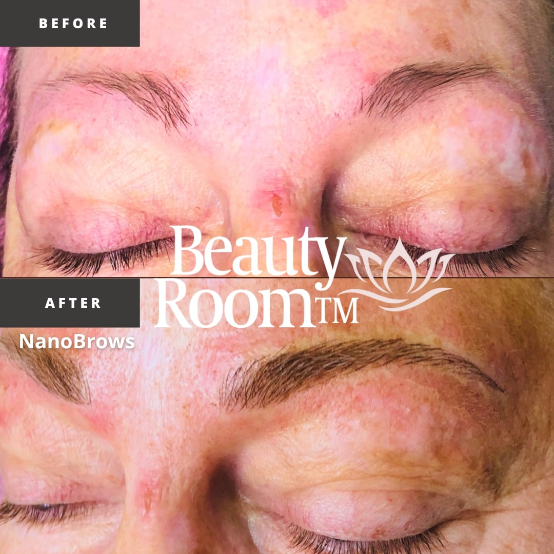 Before and After Image: NanoBrows - front