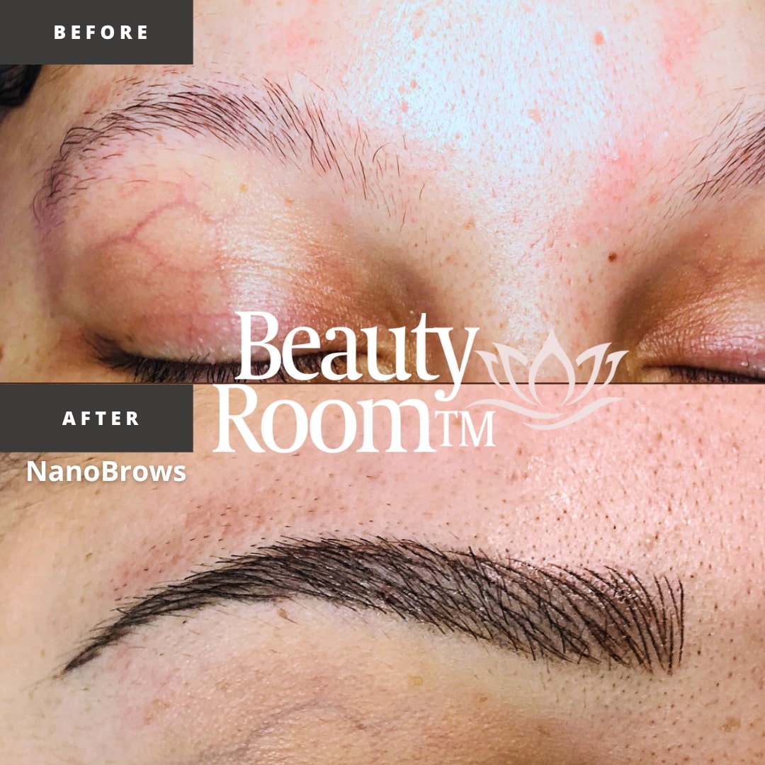 Before and After Image: NanoBrows - front