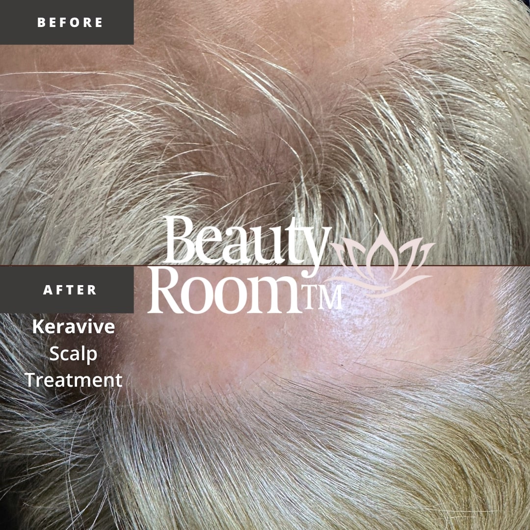 Before and After Image: Scalp Treatment - front