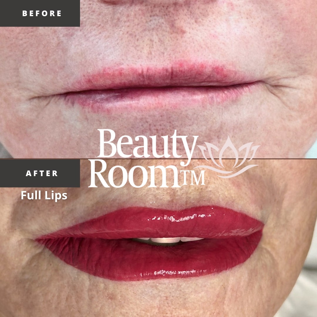 Before and After Image: Full Lips - front