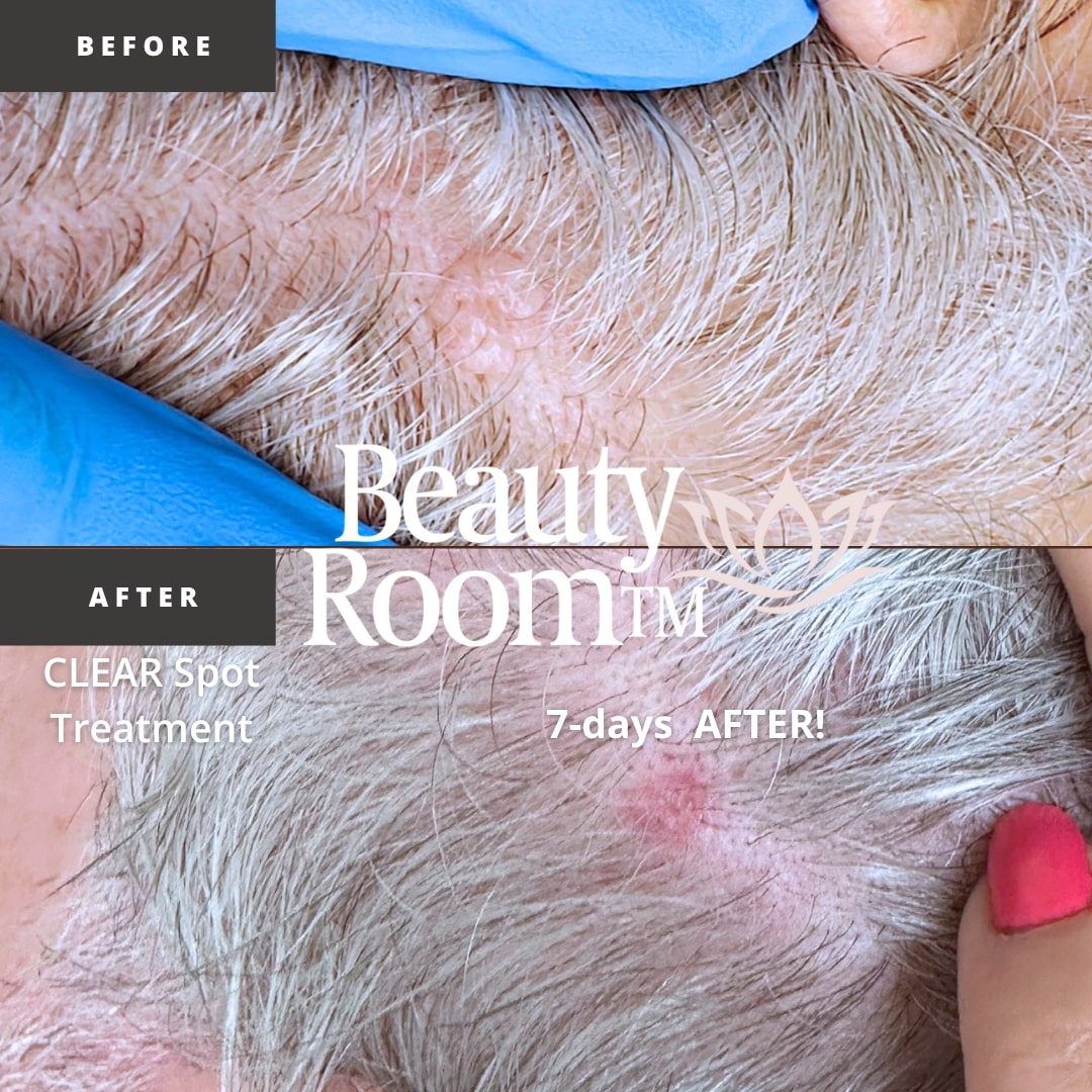 Before and After Image: Clear Spot Treatment - front