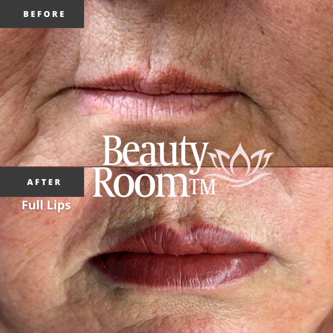 Before and After Image: Full Lips - front