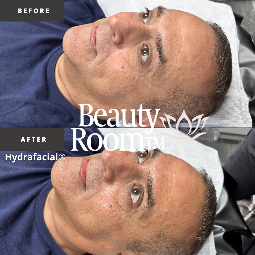 Before and After Image: Hydrafacial - front