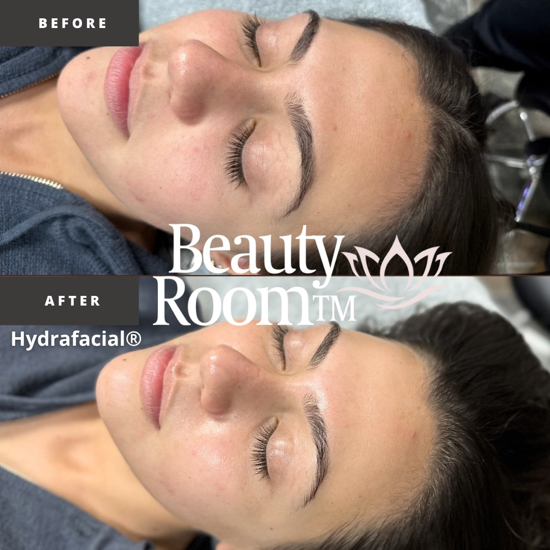 Before and After Image: Hydrafacial - front