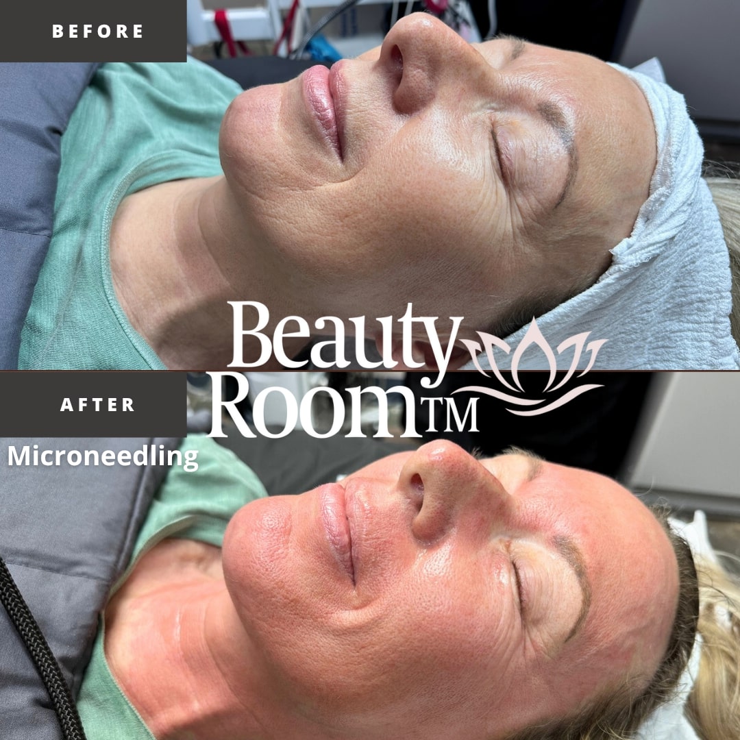 Before and After Image: Microneedling - front