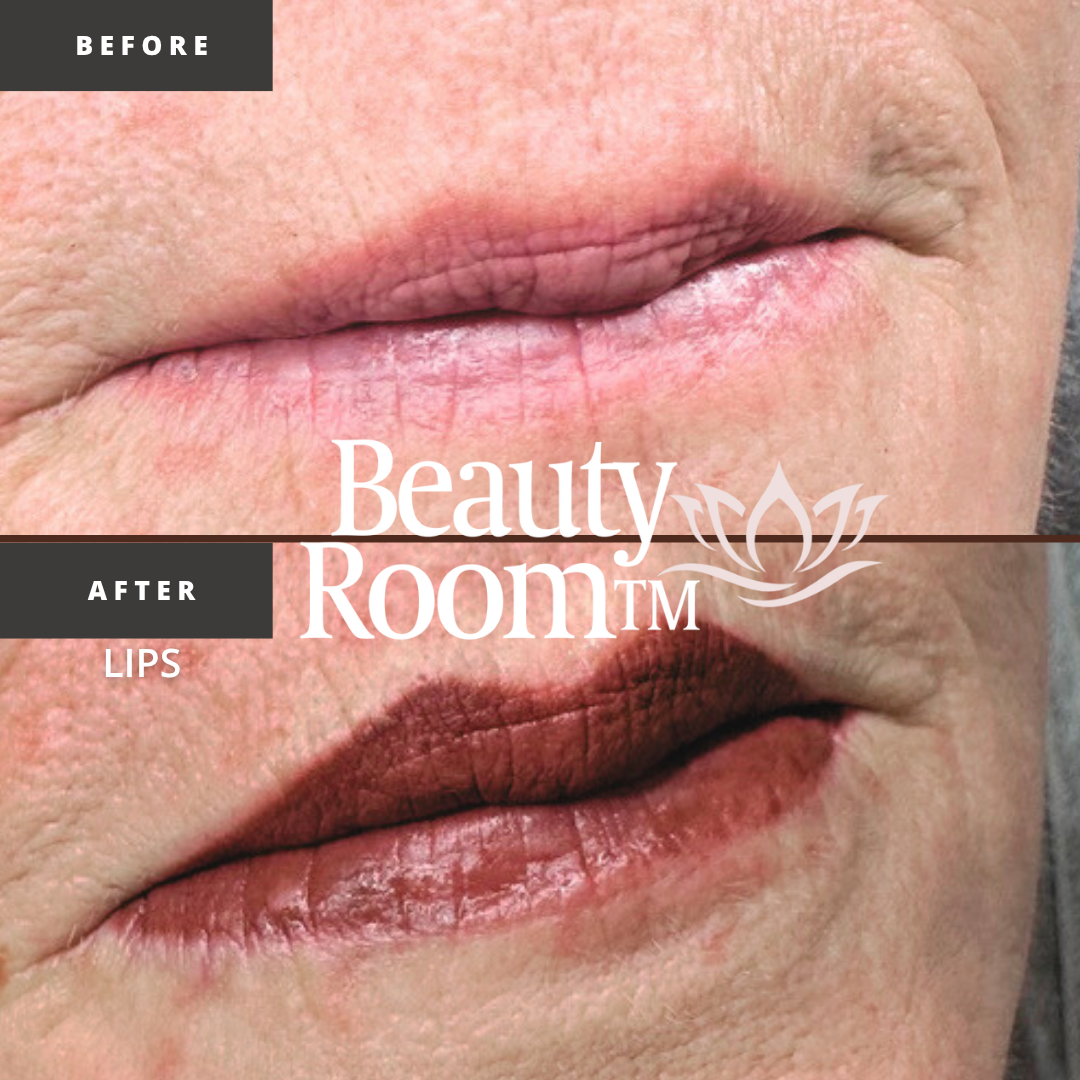 Before and After Image: Full Lips - front