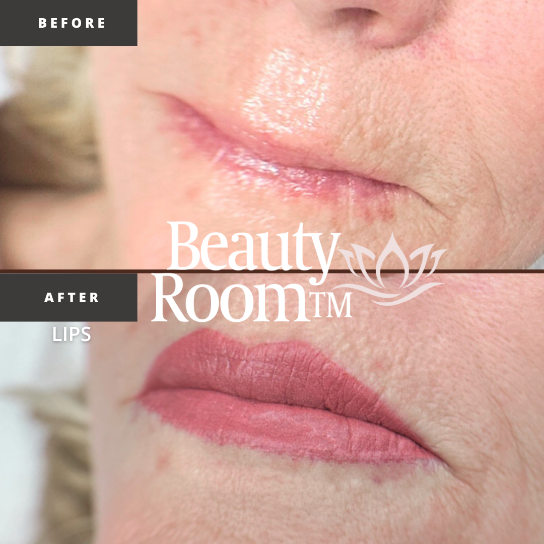 Before and After Image: Full Lips - front