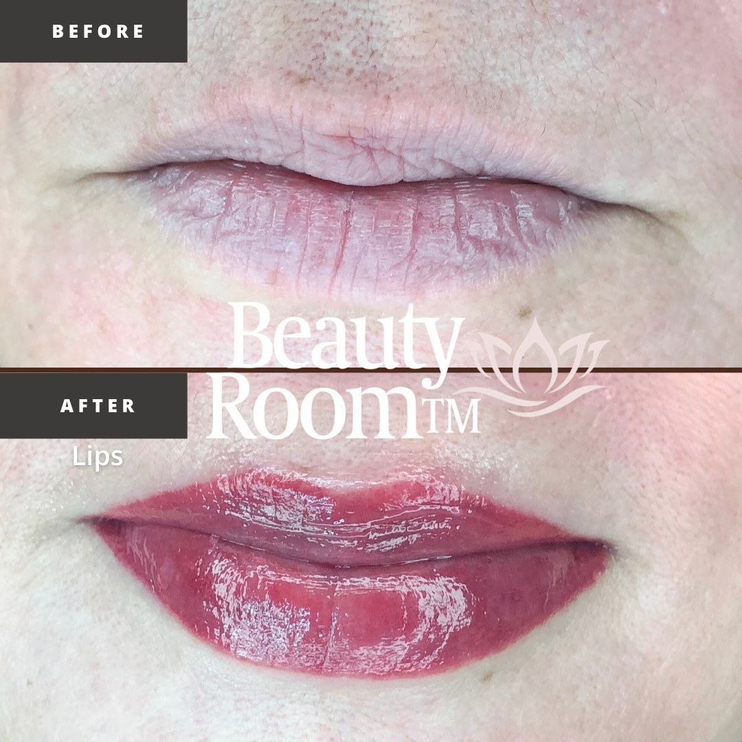 Before and After Image: Full Lips - front
