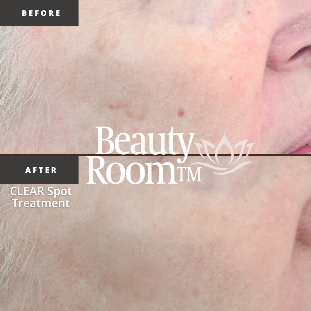 Before and After Image: CLEAR Spot Treatment - front