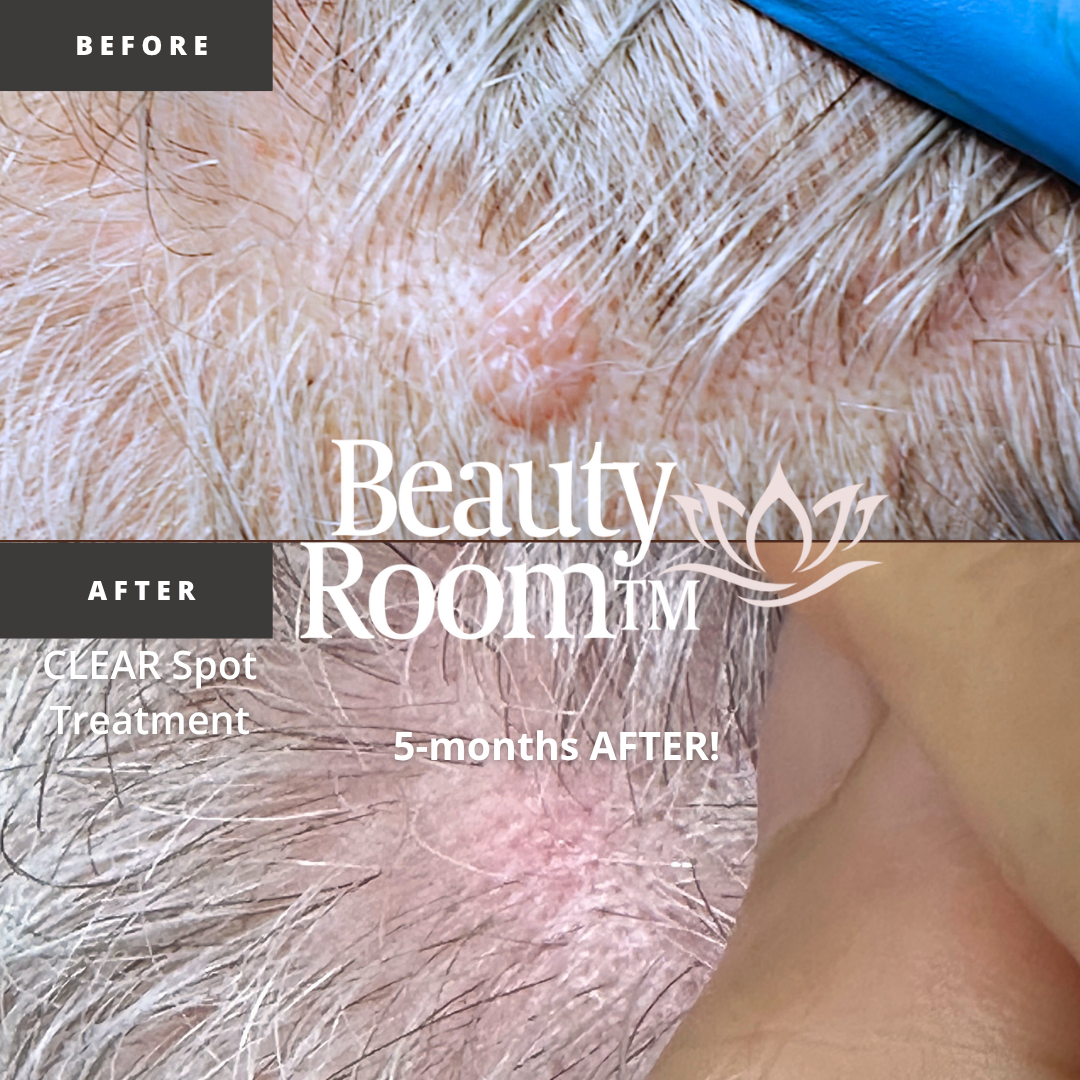 Before and After Image: CLEAR Spot Treatment - front